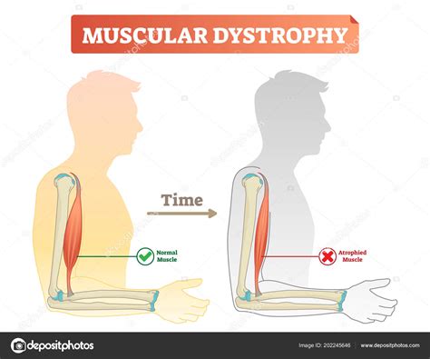 what diseases are similar to muscular dystrophy